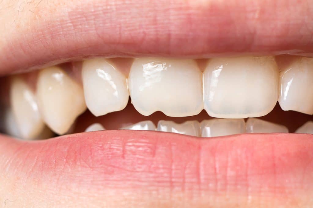 Chipped Tooth? Here's What to Do Before You See a Dentist