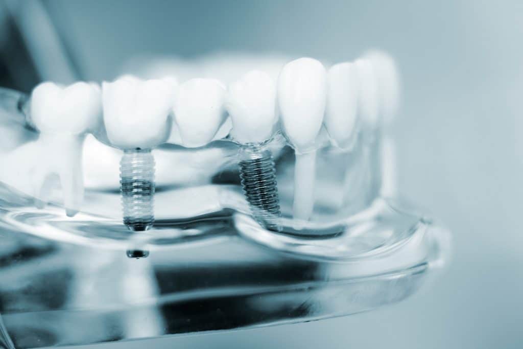 Dental Implant Alternatives: Know Your Options