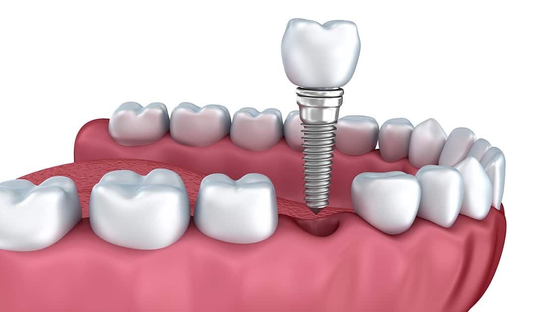 Cosmetic Bonding in Foggy Bottom - Blossom Dentistry