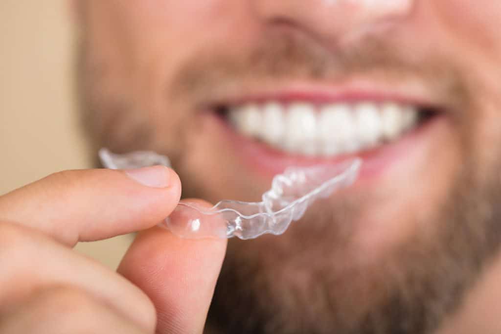 How Does Invisalign Work? An Overview Of The Invisalign Process