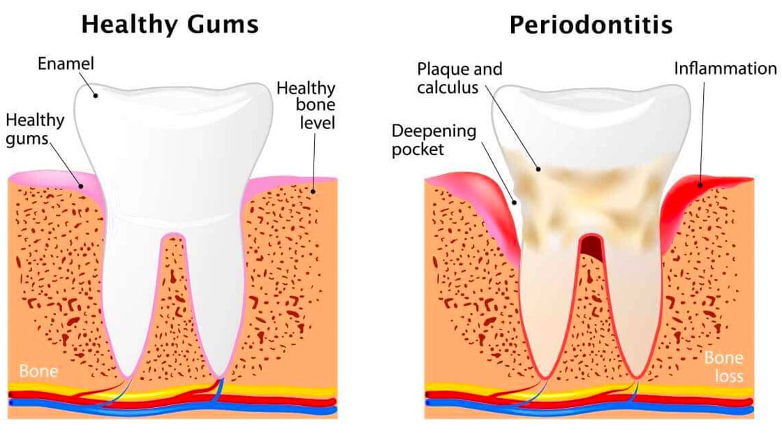 Advanced Periodontitis illustration