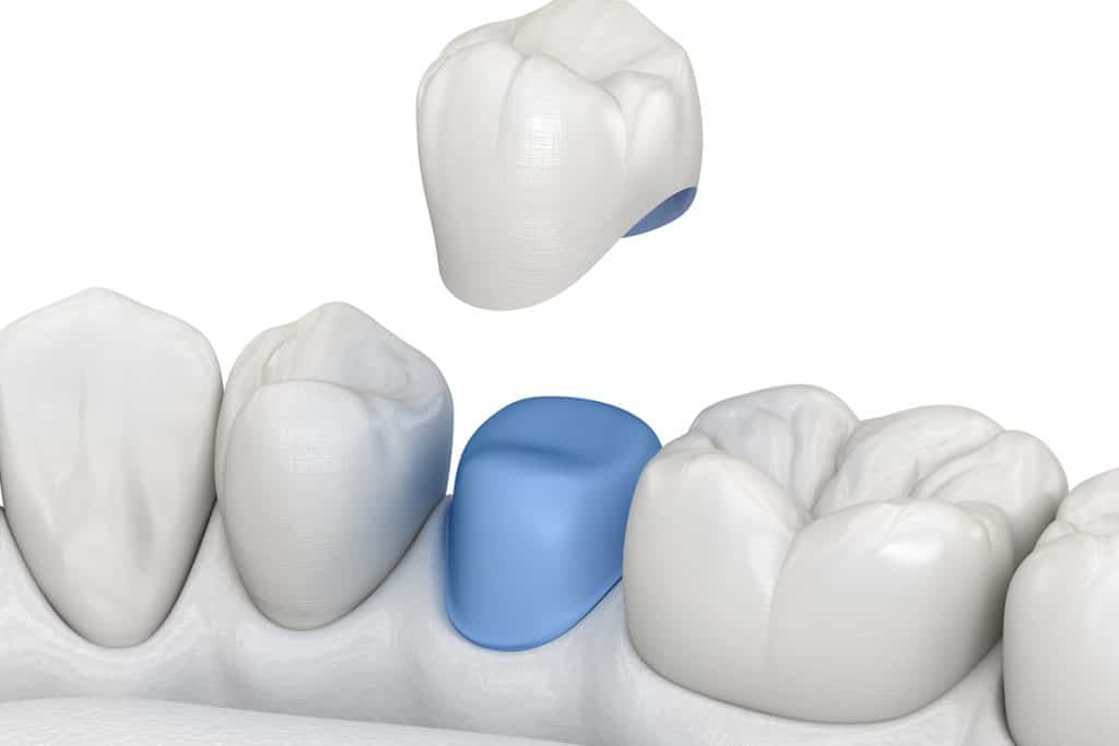 Signs You Might Need a Dental Crown Replacement