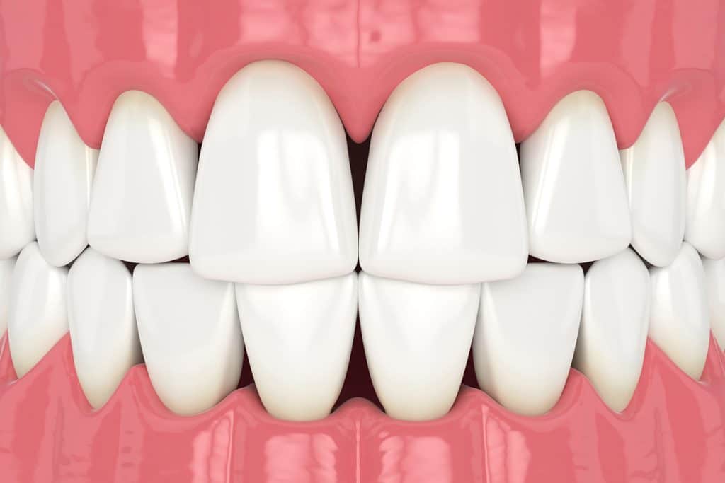 What To Do About Black Triangles Between Your Teeth