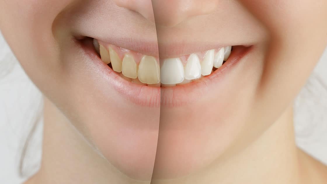 Cosmetic Bonding in Foggy Bottom - Blossom Dentistry